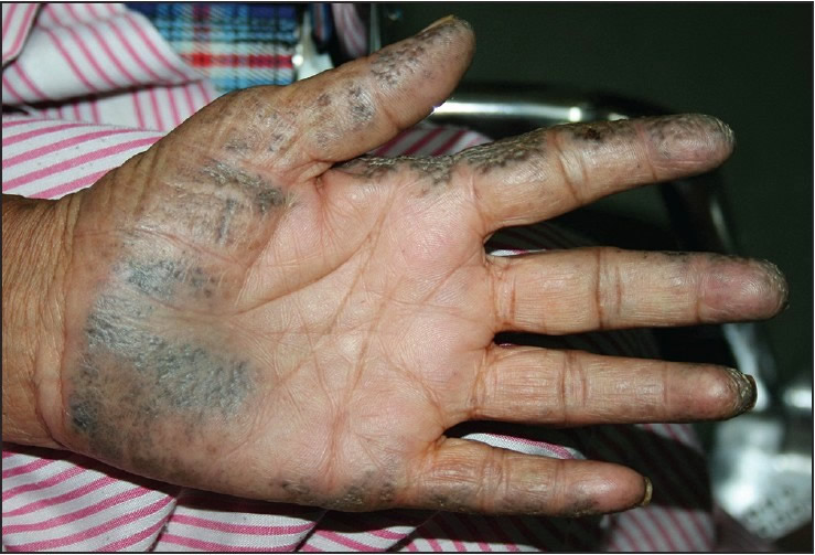 Ľudská dlaň s prejavmi choroby alkaptonúrie - sčernatenie častí pokožky.
